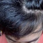 Uban Di Usia Muda: Penyebab Dan Solusi Terbaik