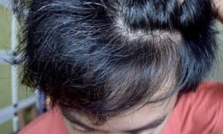 Uban Di Usia Muda: Penyebab Dan Solusi Terbaik