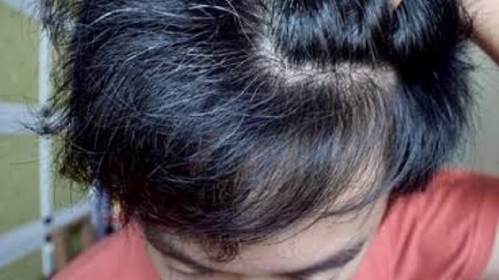 Uban Di Usia Muda: Penyebab Dan Solusi Terbaik